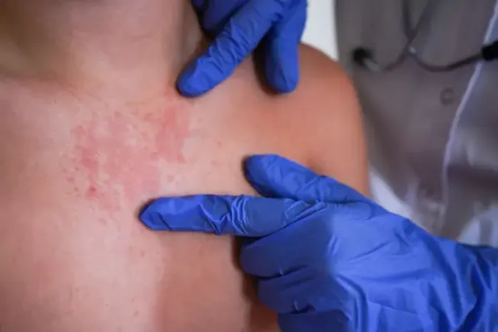 Lichen Planus vs Psoriasis: Key Differences and Insights